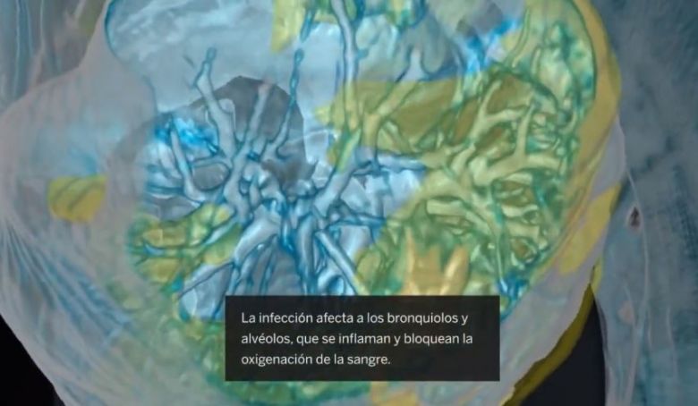 Así ataca el coronavirus en los casos más letales