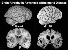 Mantenerse activo físicamente protege contra el envejecimiento del cerebro