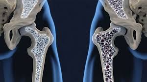 Osteoporosis: ¿un mal que afecta solo a las mujeres?