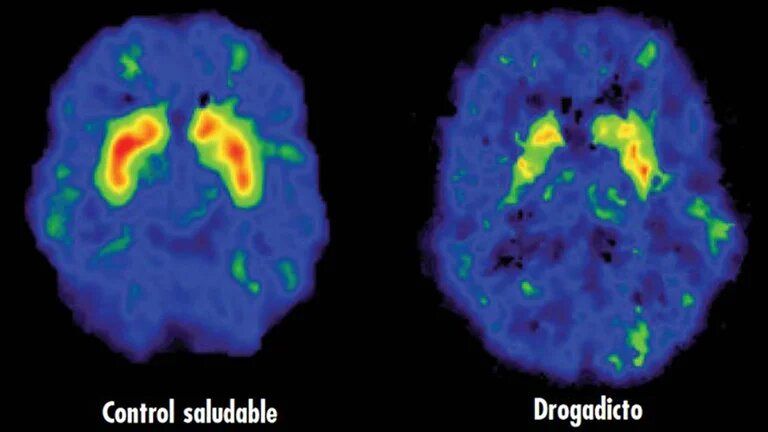 Así impacta la cocaína en el cerebro de las personas