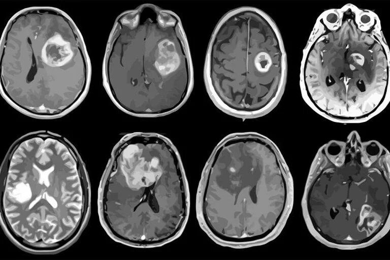 Tumor cerebral: qué es y cómo se trata la enfermedad que padeció Gerardo Rozin