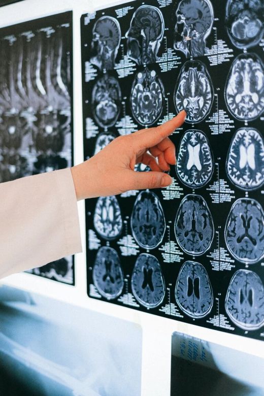 Tumor cerebral: qué es y cómo se trata la enfermedad que padeció Gerardo Rozin