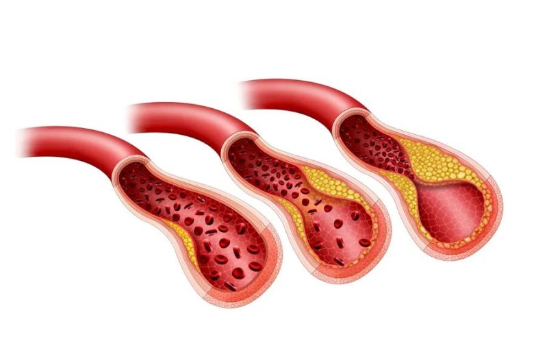 Publicado en Science Advances: descubren el rol clave de la galectina-1, una proteína que podría prevenir la aterosclerosis