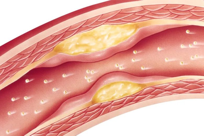 Publicado en Science Advances: descubren el rol clave de la galectina-1, una proteína que podría prevenir la aterosclerosis