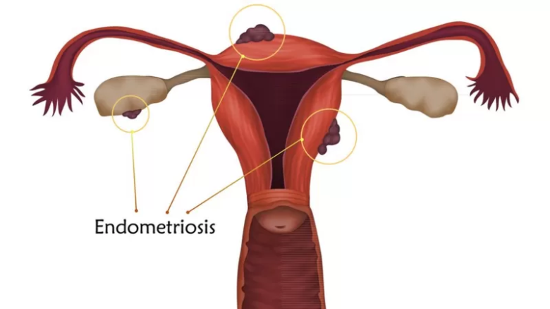 Cuándo debemos preocuparnos por el dolor durante la menstruación y cuándo no